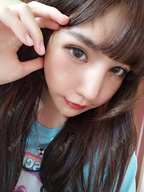 更美 - 龙喵ɑ^0^的膨体垫下巴经验 | 南宁 | 膨体垫下巴