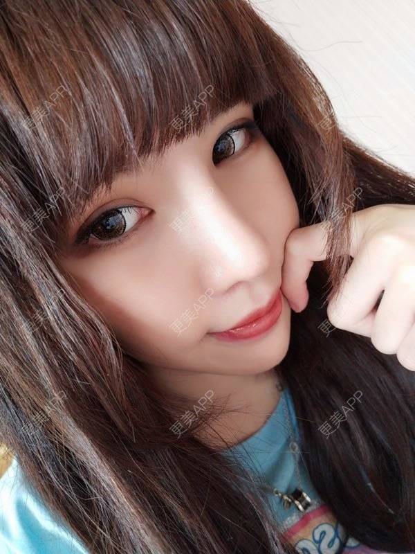 更美 - 龙喵ɑ^0^的膨体垫下巴经验 | 南宁 | 膨体垫下巴