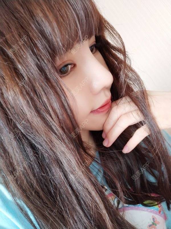 更美 - 龙喵ɑ^0^的膨体垫下巴经验 | 南宁 | 膨体垫下巴