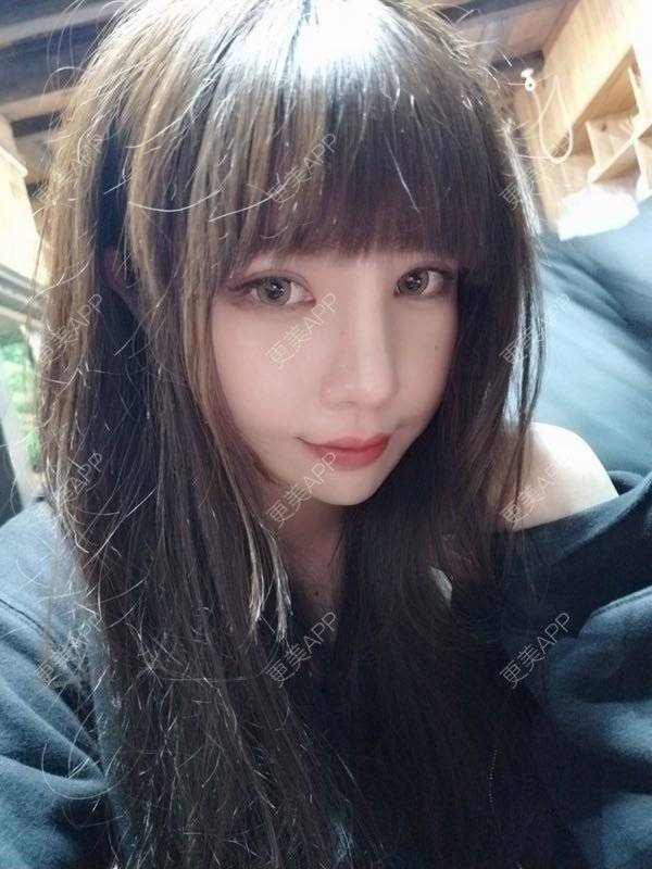 更美 - 龙喵ɑ^0^的膨体垫下巴经验 | 南宁 | 膨体垫下巴