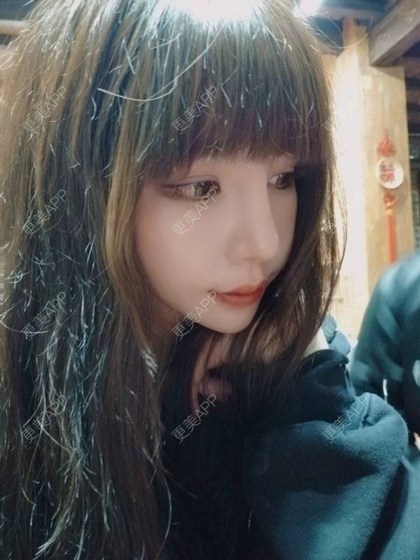 更美 - 龙喵ɑ^0^的膨体垫下巴经验 | 南宁 | 膨体垫下巴