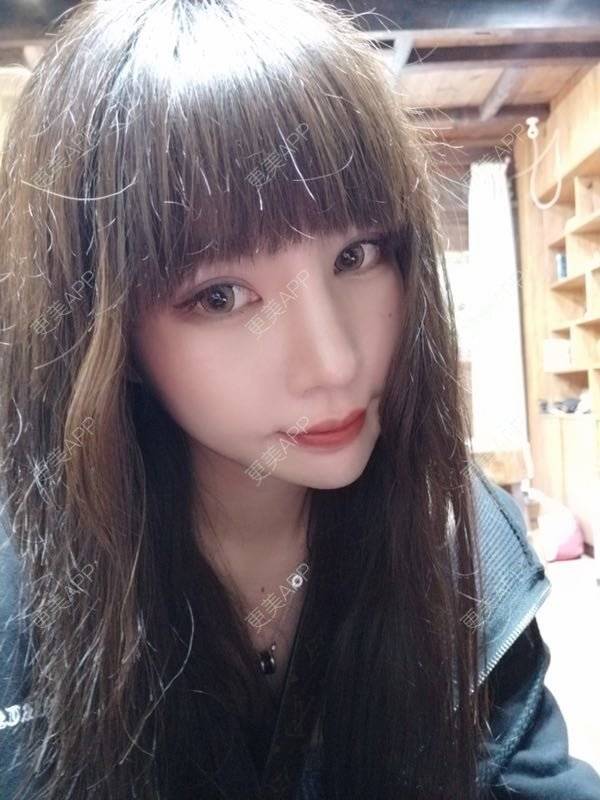 更美 - 龙喵ɑ^0^的膨体垫下巴经验 | 南宁 | 膨体垫下巴