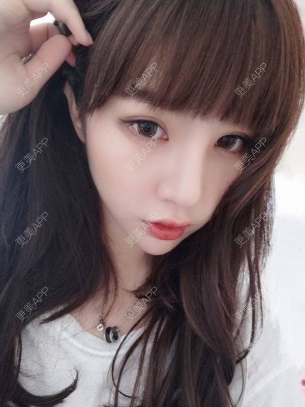 更美 - 龙喵ɑ^0^的膨体垫下巴经验 | 南宁 | 膨体垫下巴