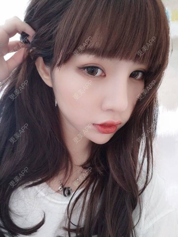 更美 - 龙喵ɑ^0^的膨体垫下巴经验 | 南宁 | 膨体垫下巴