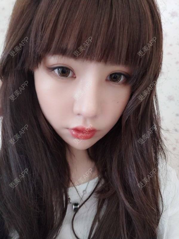 更美 - 龙喵ɑ^0^的膨体垫下巴经验 | 南宁 | 膨体垫下巴