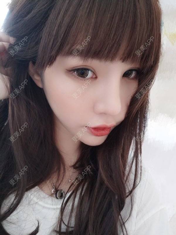 更美 - 龙喵ɑ^0^的膨体垫下巴经验 | 南宁 | 膨体垫下巴