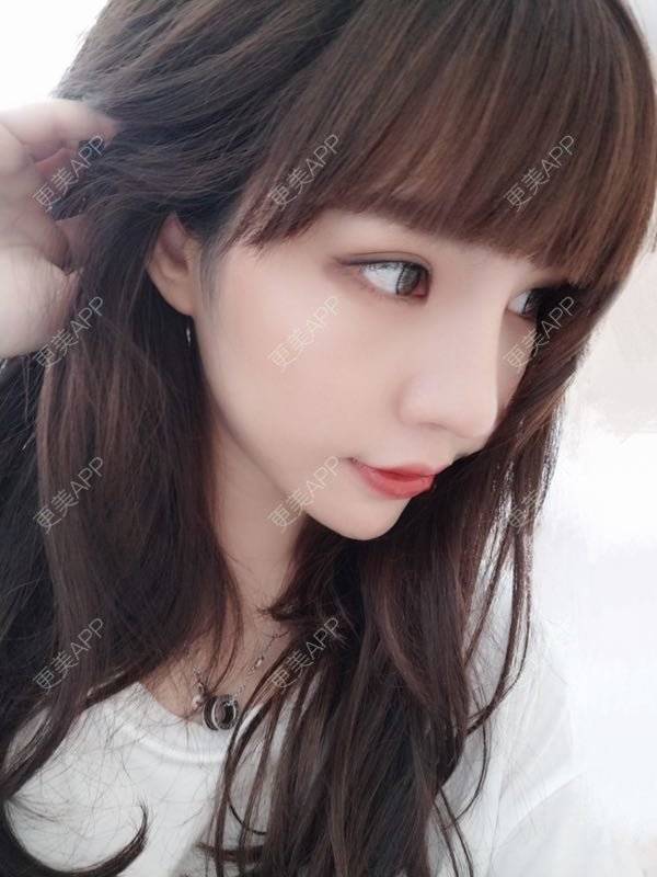 更美 - 龙喵ɑ^0^的膨体垫下巴经验 | 南宁 | 膨体垫下巴