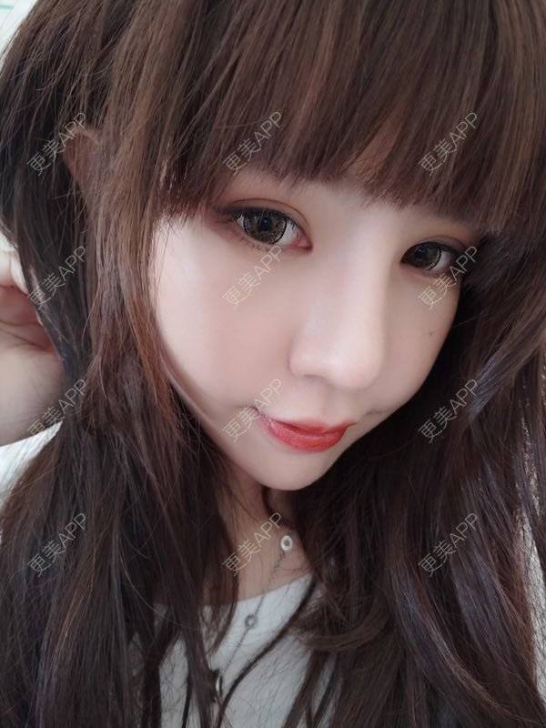 更美 - 龙喵ɑ^0^的膨体垫下巴经验 | 南宁 | 膨体垫下巴