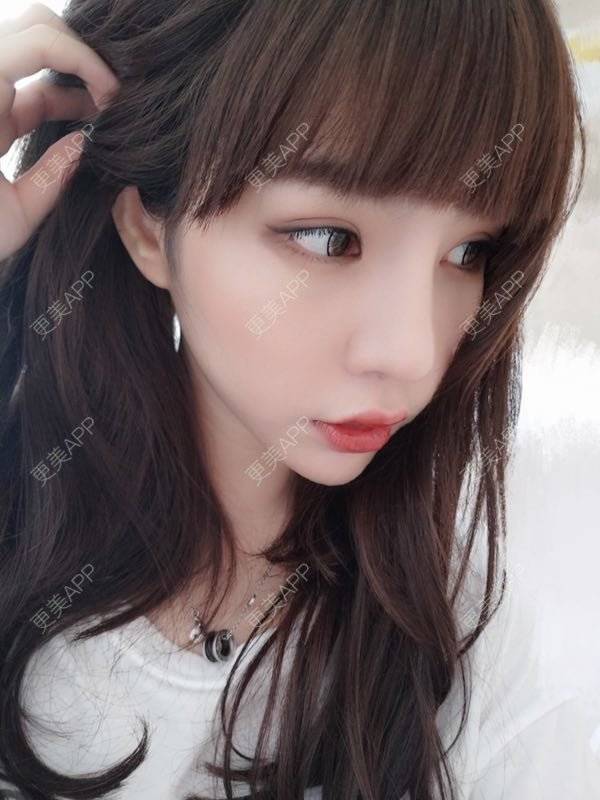 更美 - 龙喵ɑ^0^的膨体垫下巴经验 | 南宁 | 膨体垫下巴