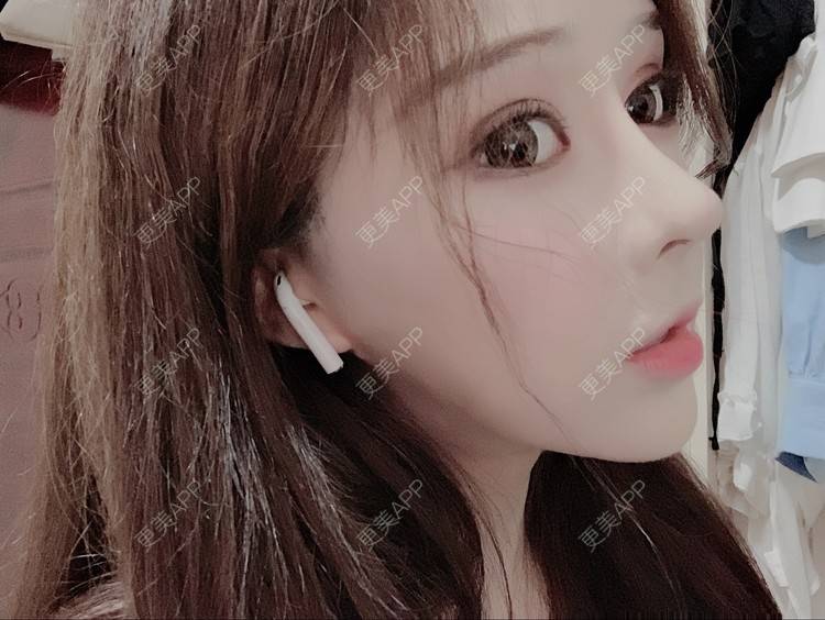 更美 - 小精玲的玻尿酸唇部经验 | 玻尿酸唇部 | 深圳