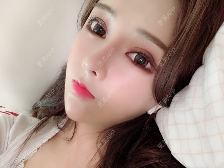 更美 - 小精玲的玻尿酸唇部经验 | 玻尿酸唇部 | 深圳