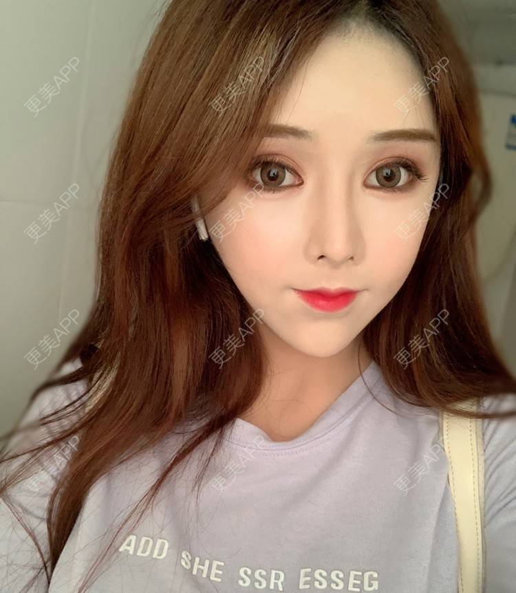 更美 - 小精玲的玻尿酸唇部经验 | 玻尿酸唇部 | 深圳