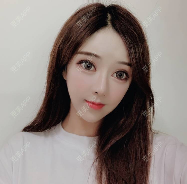 更美 - 小精玲的玻尿酸唇部经验 | 玻尿酸唇部 | 深圳