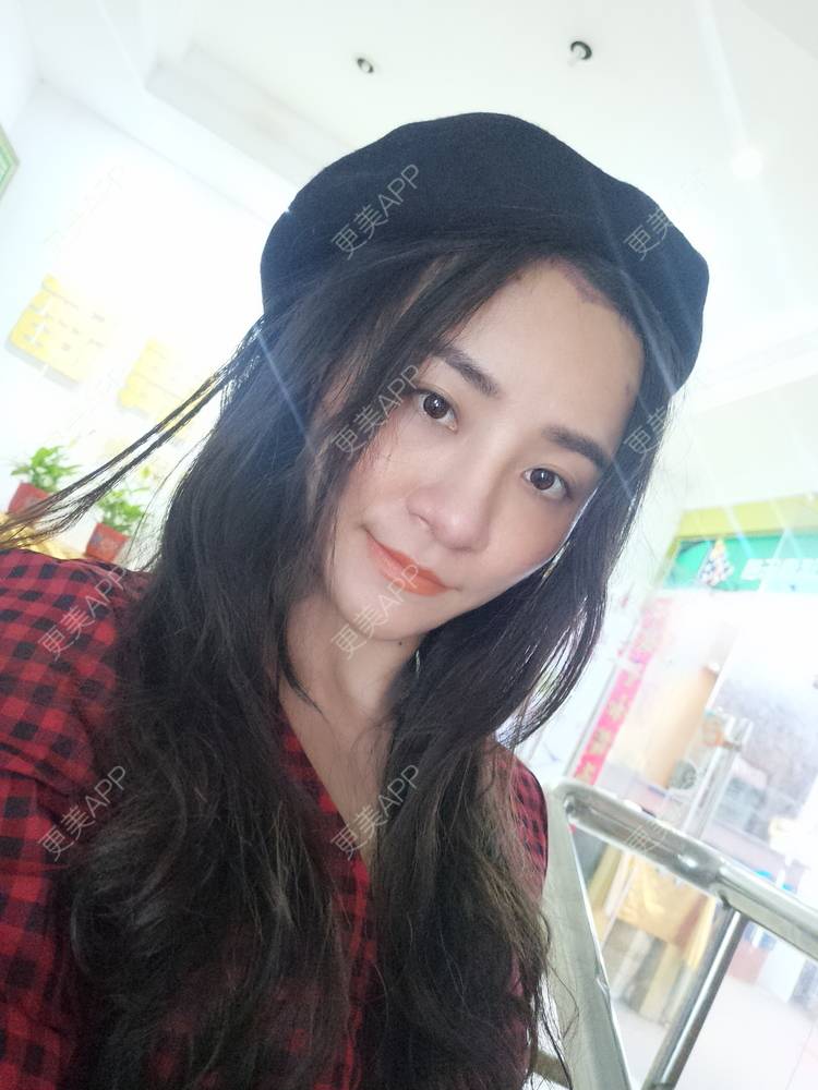更美 - 大白的植发际线经验 | 植发际线 | 广州