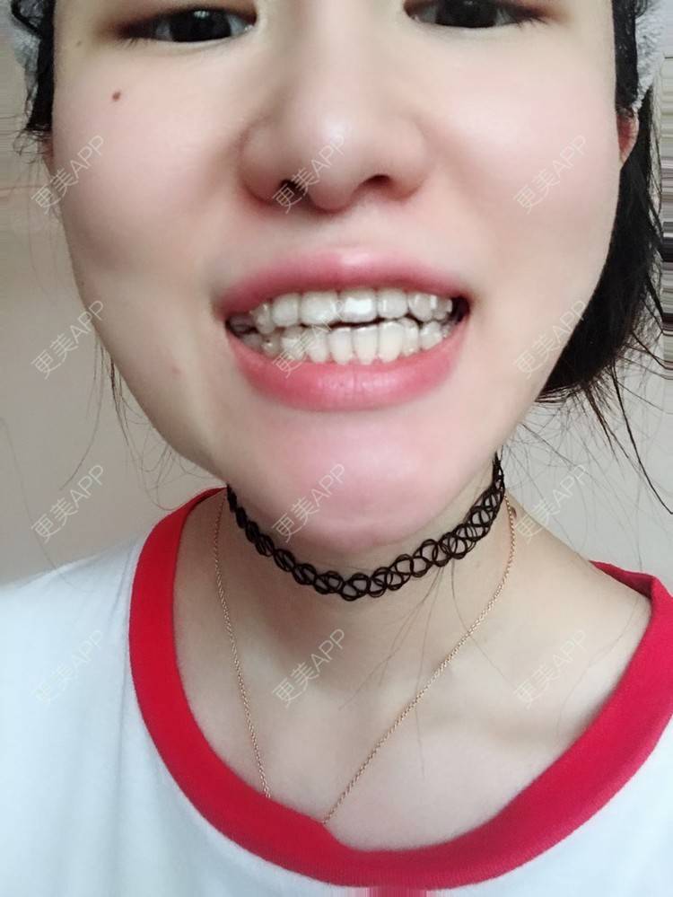 更美用户i3yd6wjil4的隐形牙齿矫正日记