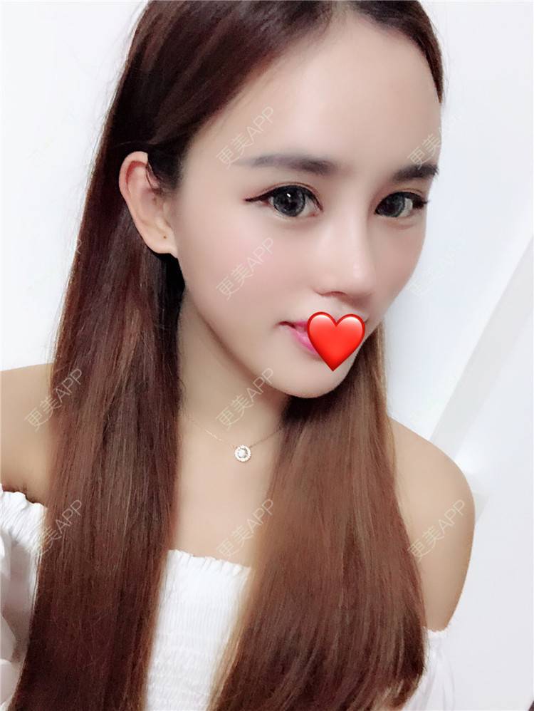 晴sunshine的膨体隆鼻日记