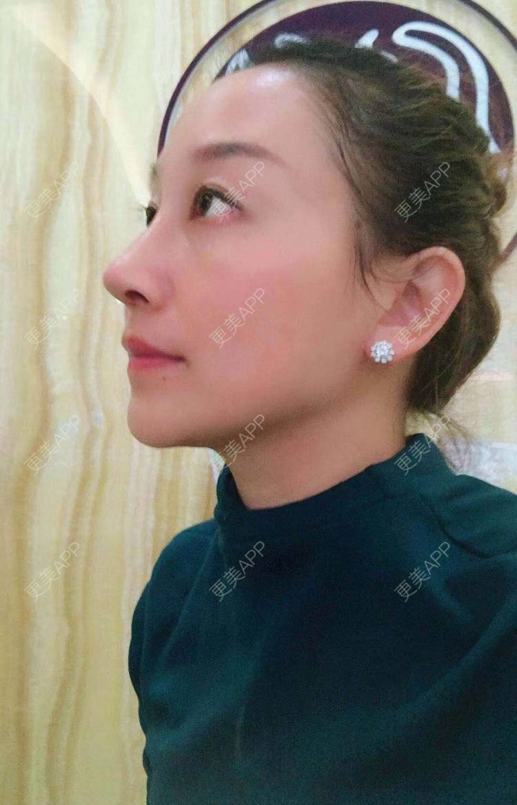 更美 - 一丁点点的鼻部多项经验 | 耳软骨隆鼻 | 驼峰鼻矫正 | 鼻部多项 | 广州