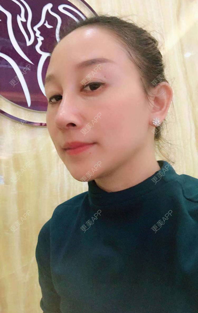更美 - 一丁点点的鼻部多项经验 | 耳软骨隆鼻 | 驼峰鼻矫正 | 鼻部多项 | 广州