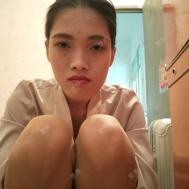 面部不对称矫正