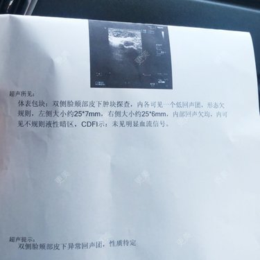 颧弓降低