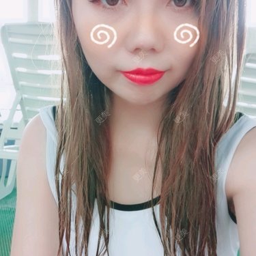 鼻中隔软骨隆鼻