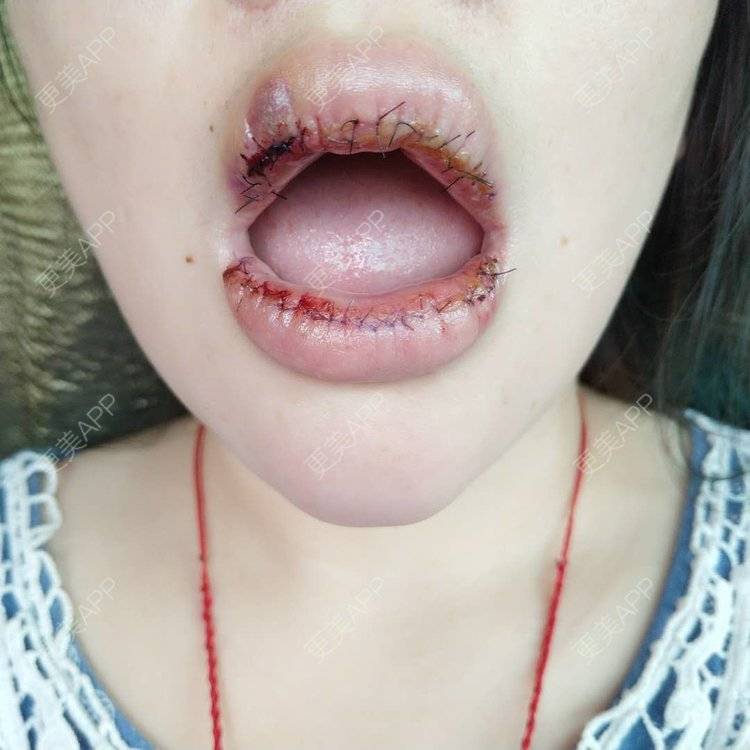 更美用户fj4feyvutw的厚唇改薄术日记