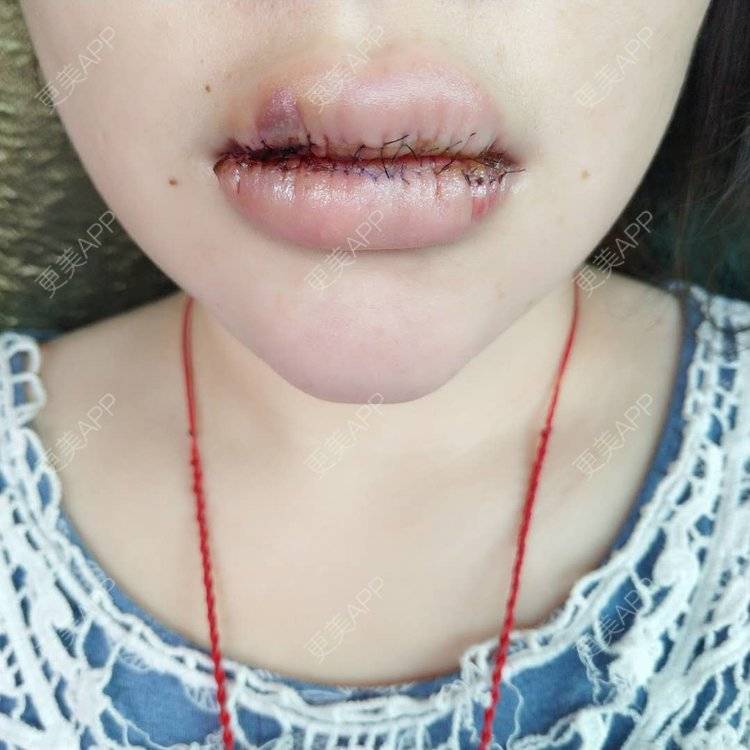 更美用户fj4feyvutw的厚唇改薄术日记
