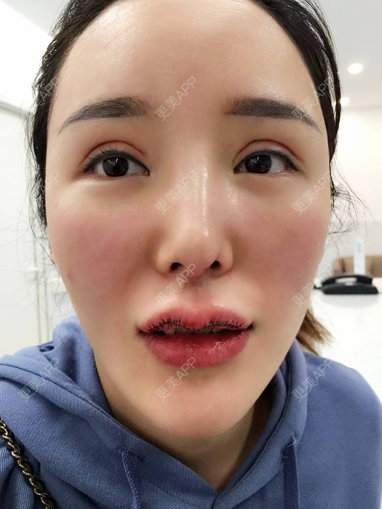 m唇成形术整形_更美用户k0ogqrqvo0m唇成形术整形_术后6天__更美