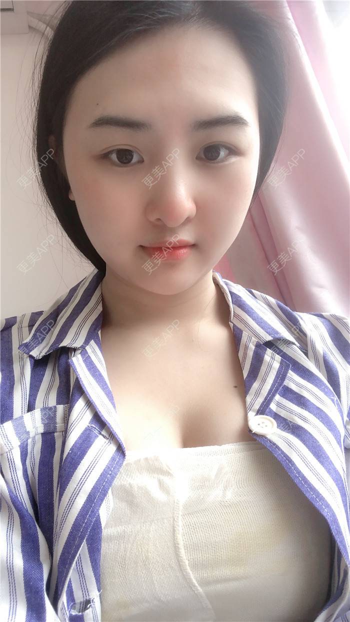 更美用户0btjy314u2的自体脂肪隆胸日记