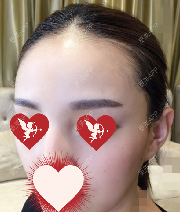 更美 - 更美用户fqrsQg5Plo的半永久纹发际线经验 | 半永久纹发际线 | 北京