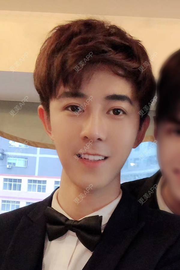 更美 - 唐航 医生的隆鼻经验 | 深圳 | 隆鼻