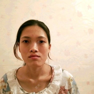 面部不对称矫正