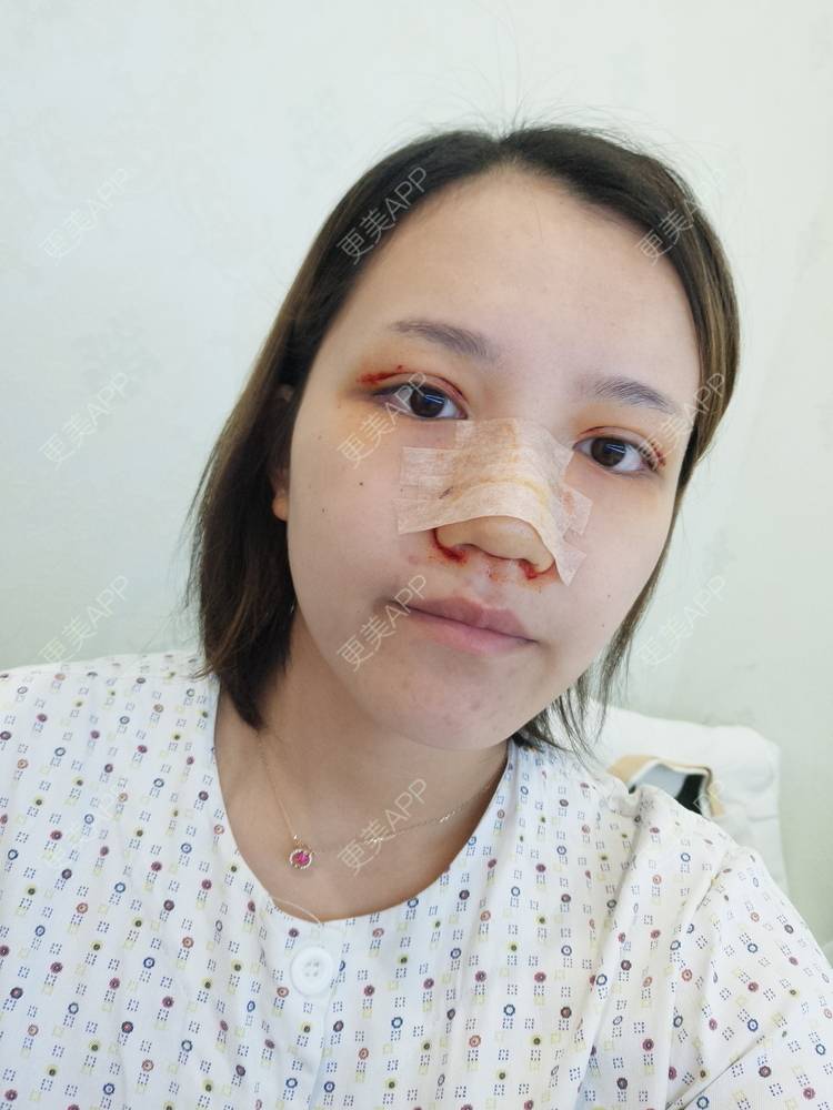 更美 - Amamiy的开眼角经验 | 开内眼角 | 眼部多项 | 开眼角
