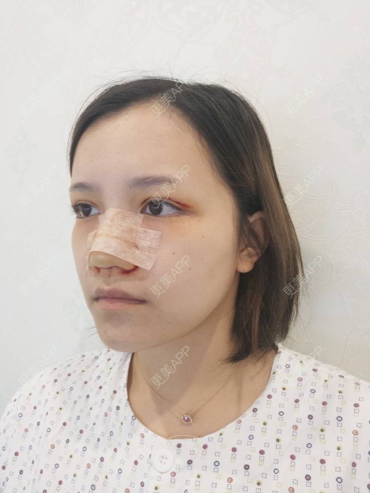更美 - Amamiy的开眼角经验 | 开内眼角 | 眼部多项 | 开眼角