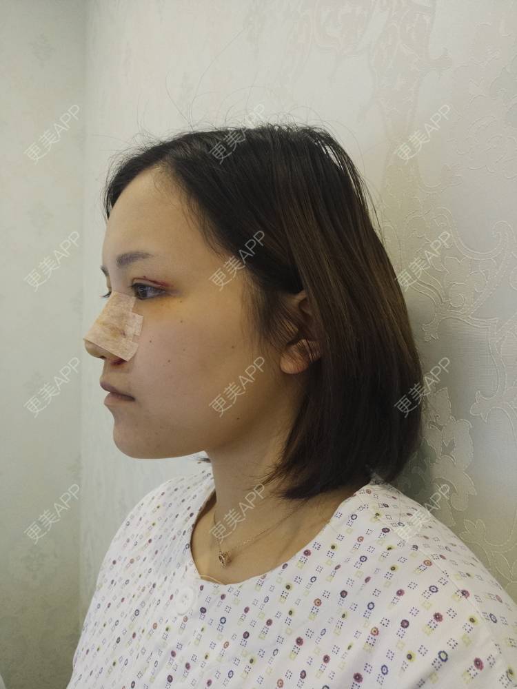 更美 - Amamiy的开眼角经验 | 开内眼角 | 眼部多项 | 开眼角