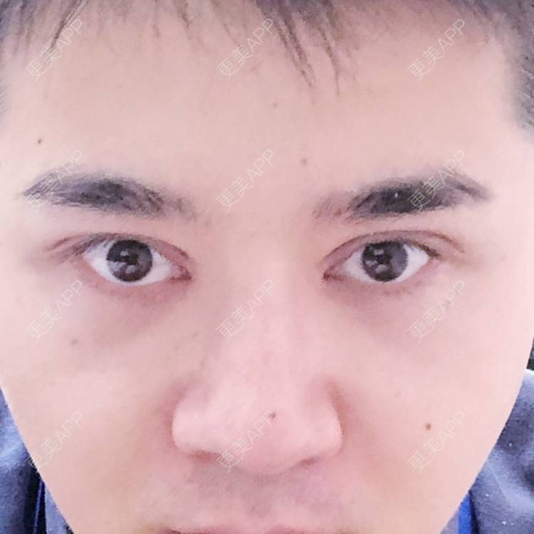 更美 - 棕棕2018的双眼皮经验 | 双眼皮修复 | 内切去眼袋 | 开内眼角 | 双眼皮 | 广州