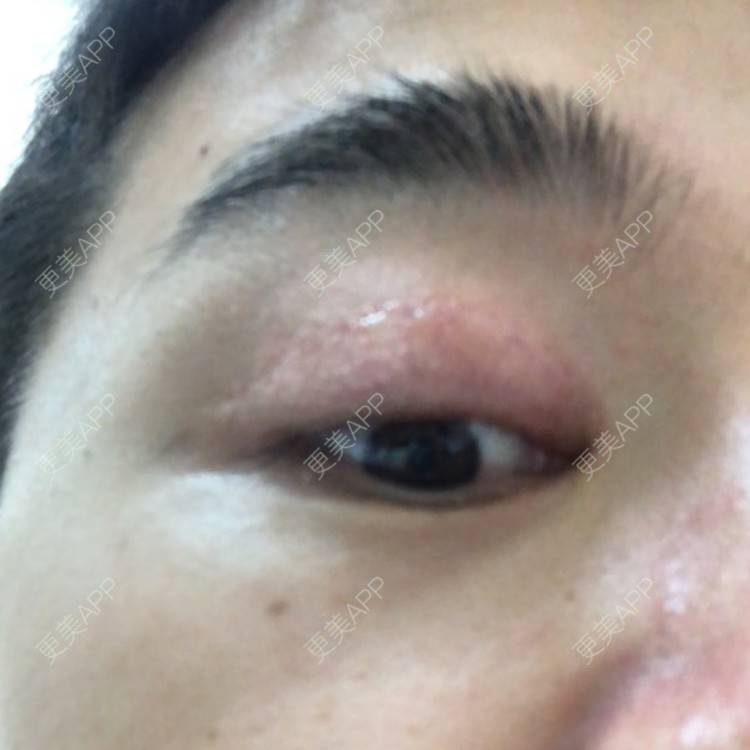 更美 - 棕棕2018的双眼皮经验 | 双眼皮修复 | 内切去眼袋 | 开内眼角 | 双眼皮 | 广州