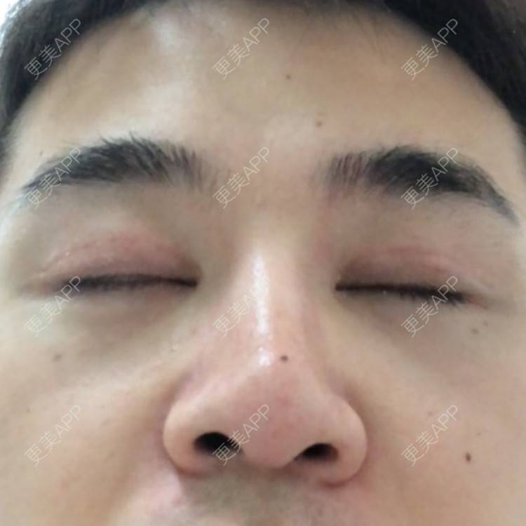 更美 - 棕棕2018的双眼皮经验 | 双眼皮修复 | 内切去眼袋 | 开内眼角 | 双眼皮 | 广州