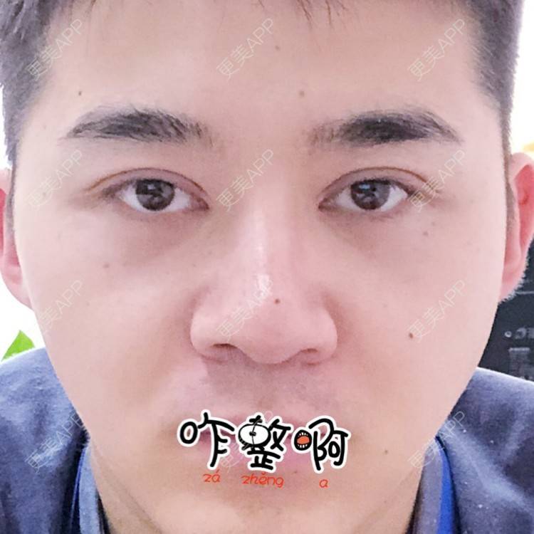 更美 - 棕棕2018的双眼皮经验 | 双眼皮修复 | 内切去眼袋 | 开内眼角 | 双眼皮 | 广州