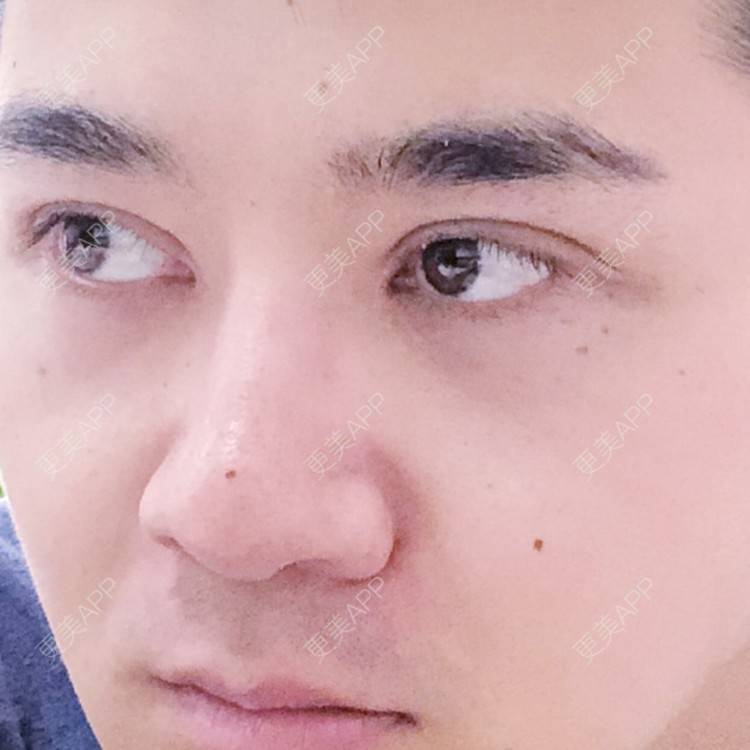 更美 - 棕棕2018的双眼皮经验 | 双眼皮修复 | 内切去眼袋 | 开内眼角 | 双眼皮 | 广州