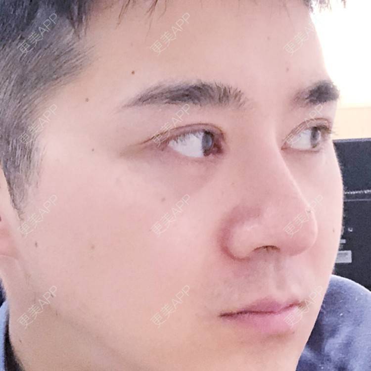 更美 - 棕棕2018的双眼皮经验 | 双眼皮修复 | 内切去眼袋 | 开内眼角 | 双眼皮 | 广州