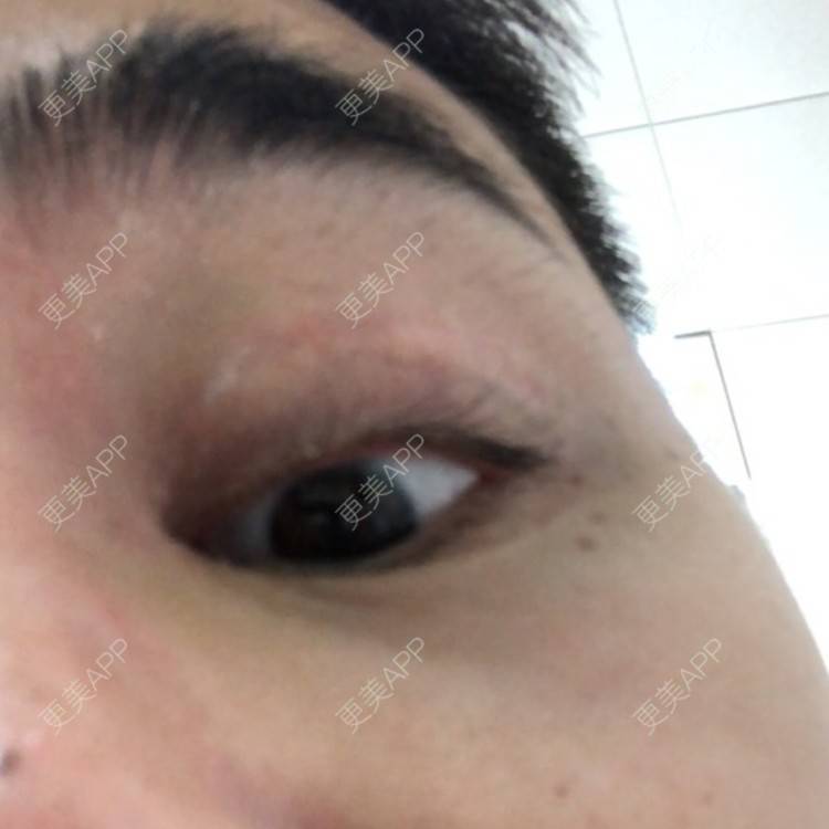 更美 - 棕棕2018的双眼皮经验 | 双眼皮修复 | 内切去眼袋 | 开内眼角 | 双眼皮 | 广州