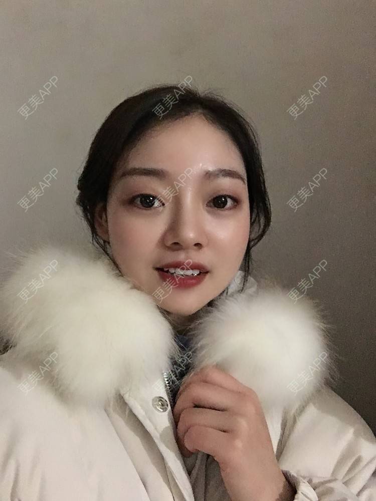 更美 - 珊瑚海。的玻尿酸套餐经验 | 玻尿酸套餐 | 成都