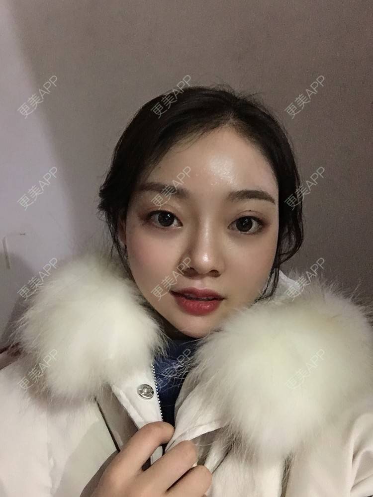 更美 - 珊瑚海。的玻尿酸套餐经验 | 玻尿酸套餐 | 成都