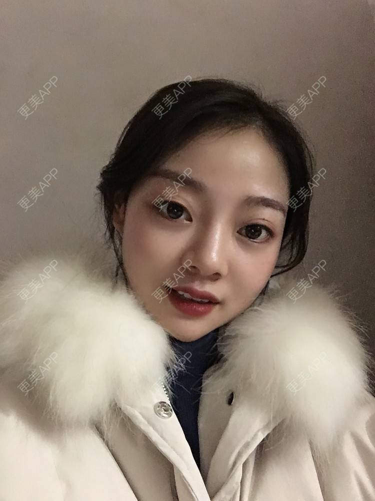 更美 - 珊瑚海。的玻尿酸套餐经验 | 玻尿酸套餐 | 成都