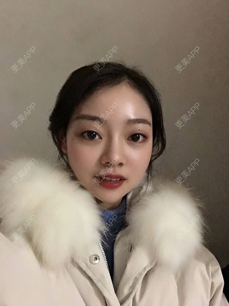 更美 - 珊瑚海。的玻尿酸套餐经验 | 玻尿酸套餐 | 成都