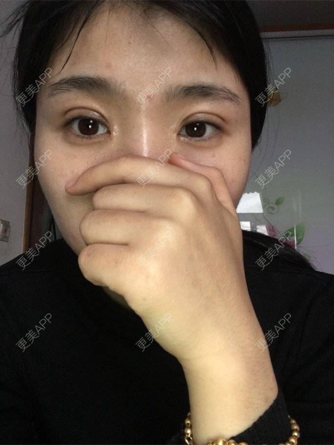 更美 - 更美用户NrtSphbqU1的全切双眼皮经验 | 宁波 | 全切双眼皮