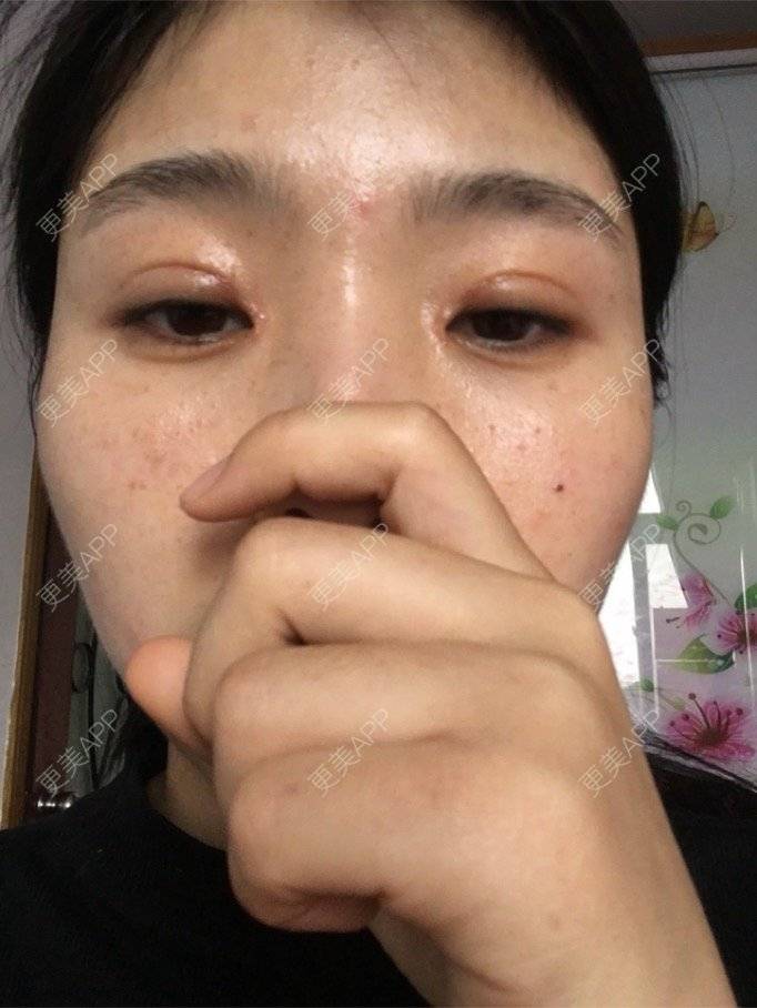 更美 - 更美用户NrtSphbqU1的全切双眼皮经验 | 宁波 | 全切双眼皮