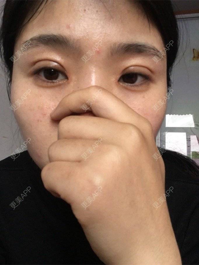 更美 - 更美用户NrtSphbqU1的全切双眼皮经验 | 宁波 | 全切双眼皮