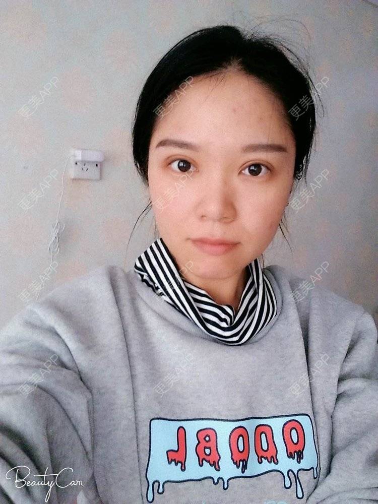 更美 - 更美用户5Pz3SpoBlS的果酸焕肤经验 | 果酸焕肤 | 济南